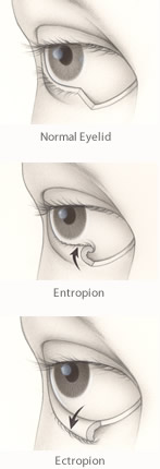 entropion & ectropion